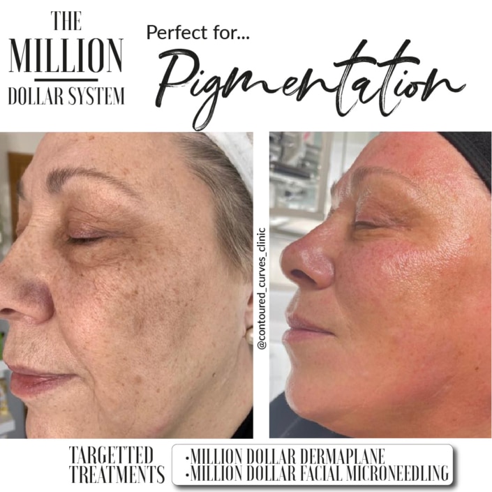 Million Dollar facial for pigmentation