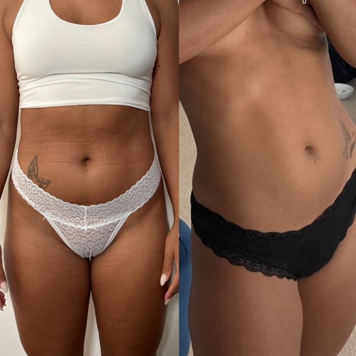 Before and after Resculpt body treatment