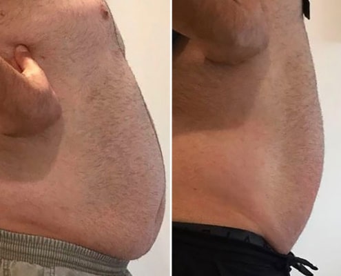 Male results from Inch loss Treatment