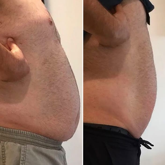 Male results from Inch loss Treatment