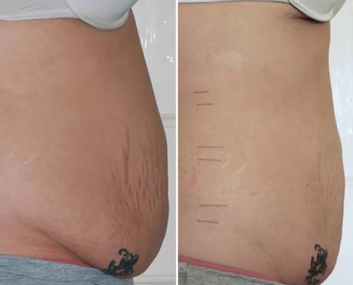 Before and after Inch Loss treatment