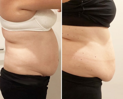 Before and after Cavitation Inch Loss treatment
