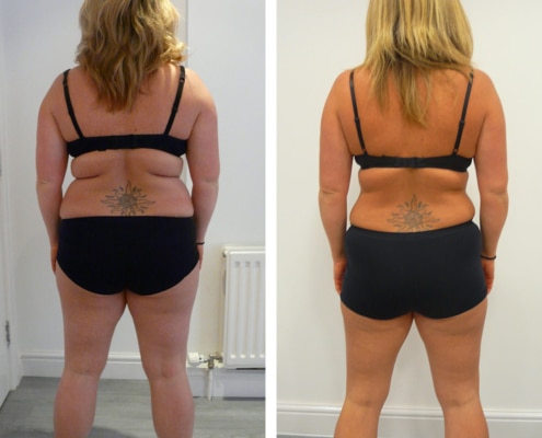 Before and after fat freezing treatment